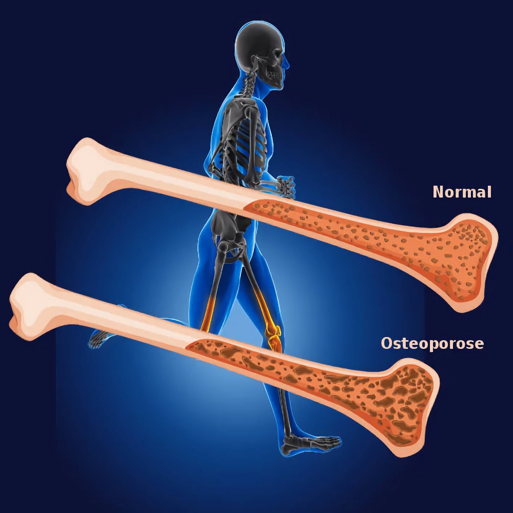 osteoporose knogleskørhed behandling Laser Medical Pro